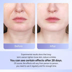 Neck Wrinkle Reduction Beauty Device