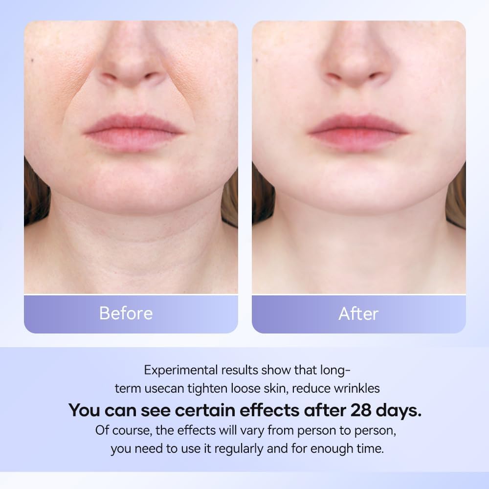 Neck Wrinkle Reduction Beauty Device